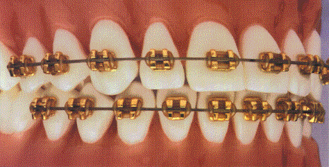 Goldene Brackets